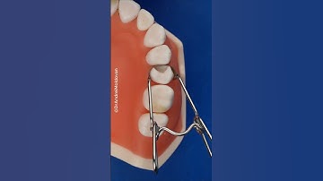 Saddle Matrix System – Efficient Dental Isolation and Restoration