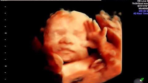 HDlive Ultrasound at  28 weeks Baby yawns and waves