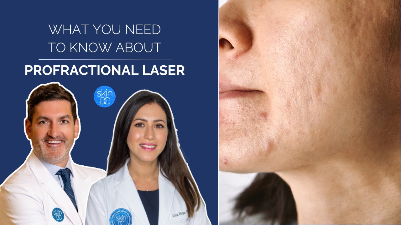 The TRUTH About ProFractional Laser || HOW It Works and WHAT It Is
