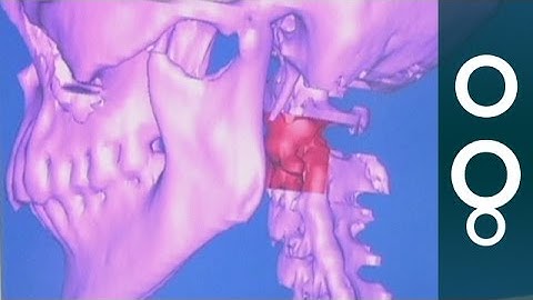 Printing Bones: First 3D Printed Vertebra Implant - Science