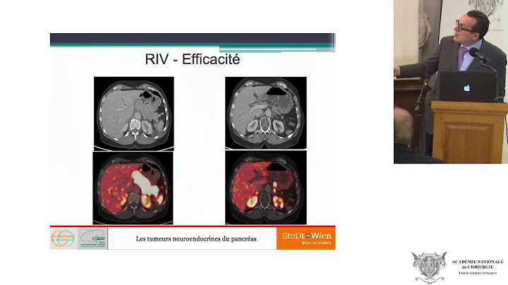 Therapeutic options in neuroendocrine tumors of the pancreas