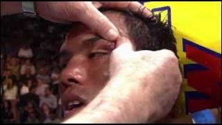 Castillo vs Corrales I