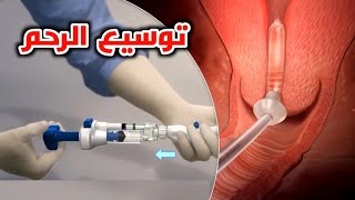 شاهد كيف يتم توسيع الرحم_definity cervical dilator