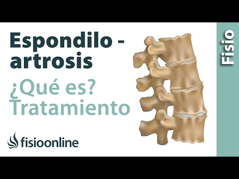 ¿Qué es la espondiloartrosis y cuál es su tratamiento?