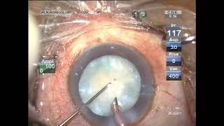 PHACO CAPSULOTOMY SERIES-STRAIGHT FROM THE OT DR NARAYAN BARDOLOI