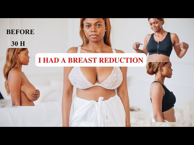 I G0T A BREAST REDUCTION/LIFT - MY RESULTS