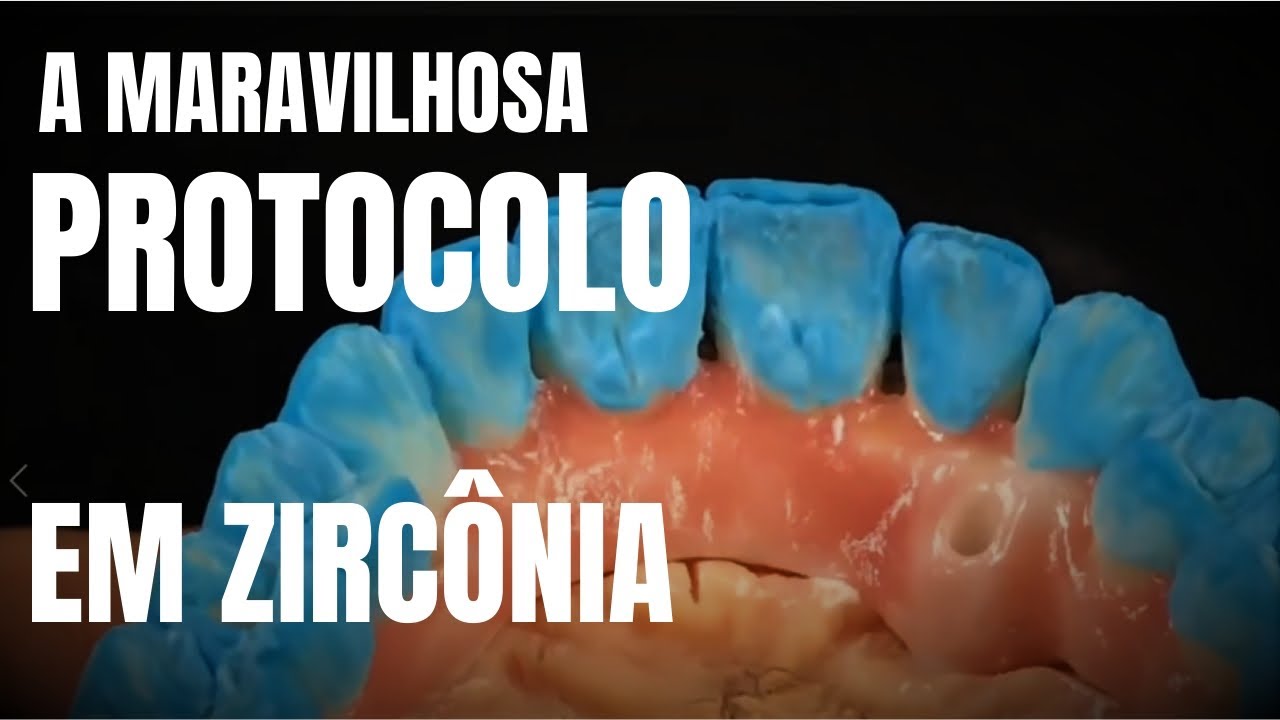 A Maravilhosa Prótese Protocolo em Zircônia