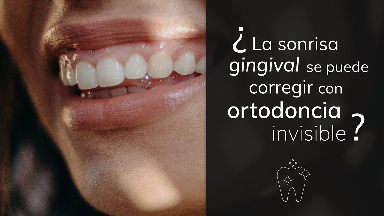 La Sonrisa Gingival Se Corrige Con Ortodoncia Invisible Youtube