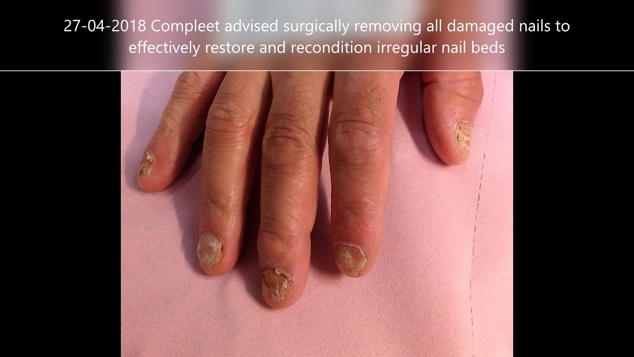 Effective Fungal Finger Nail Treatment 