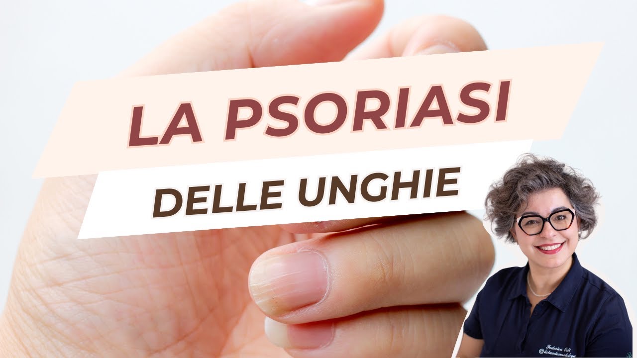 Psoriasi delle unghie 💅