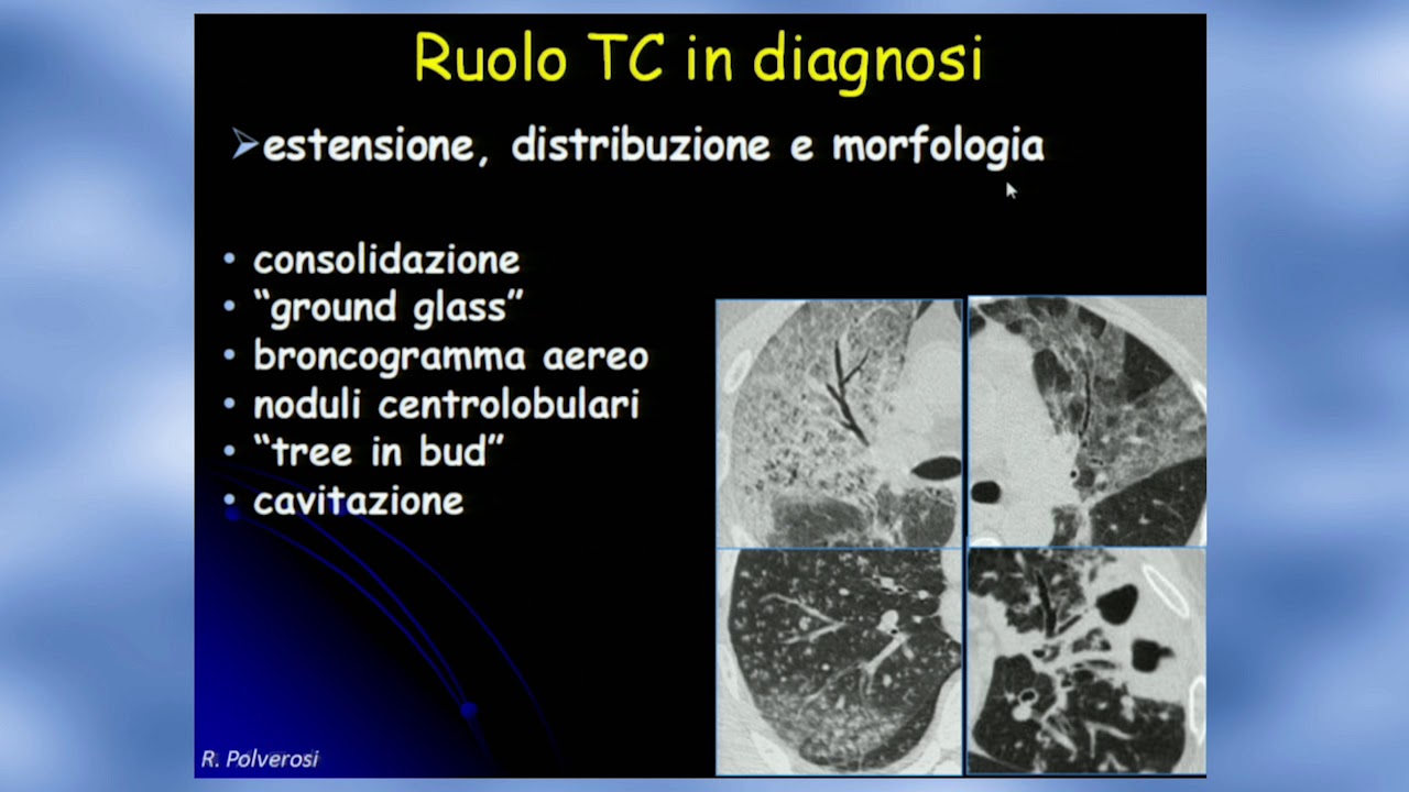 08 Polmoniti nosocomiali e acquisite in comunità. Luca Salvolini