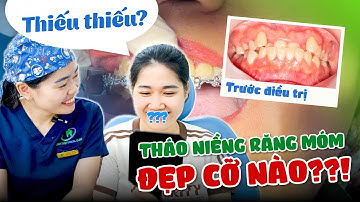 KẾT THÚC HÀNH TRÌNH NIỀNG RĂNG MÓM - SỞ HỮU NỤ CƯỜI TỰ TIN