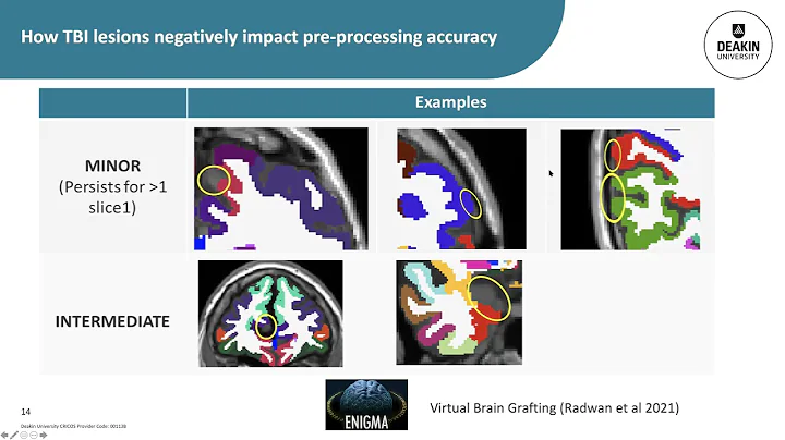 Evelyn Deutscher | Dealing with TBI Lesions during...