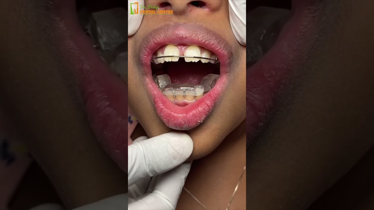 How to correct your Child's Jaw Deformity? Dr Dhivya Dilipkumar explains!