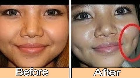 How To Get Dimples Fast & Naturally - Simple Facial Exercise to get Dimples without Surgery