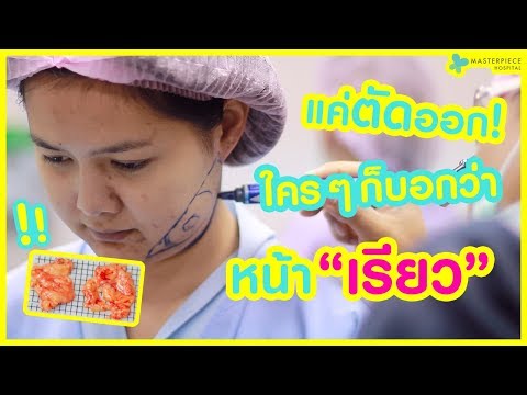 #ตัดไขมันกระพุ้งแก้ม ลดแก้มป่องถาวร ตัดออกหน้าเรียว !!!
