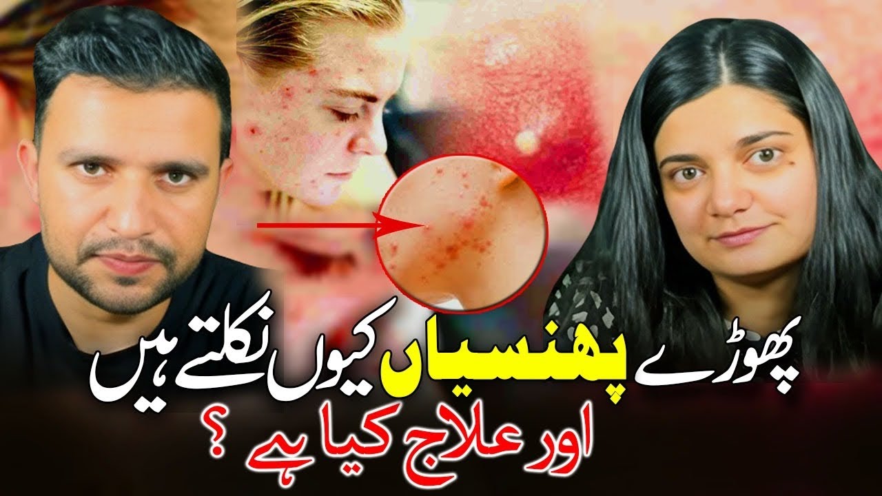 Pimples/Phorrun Ka ilaj | Treatment of Boils | The Medbros | DrShoaib | Dr Hera |