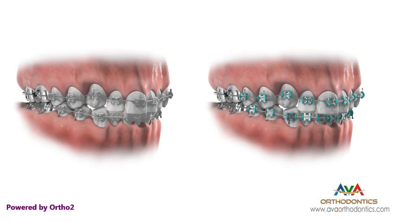Clear (AKA Ceramic) Braces vs. Metal Braces Orthodontic Treatment