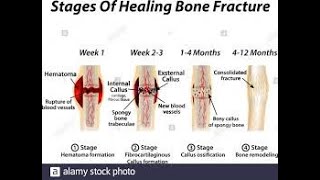 كيفية  التئام العظام   bone healing