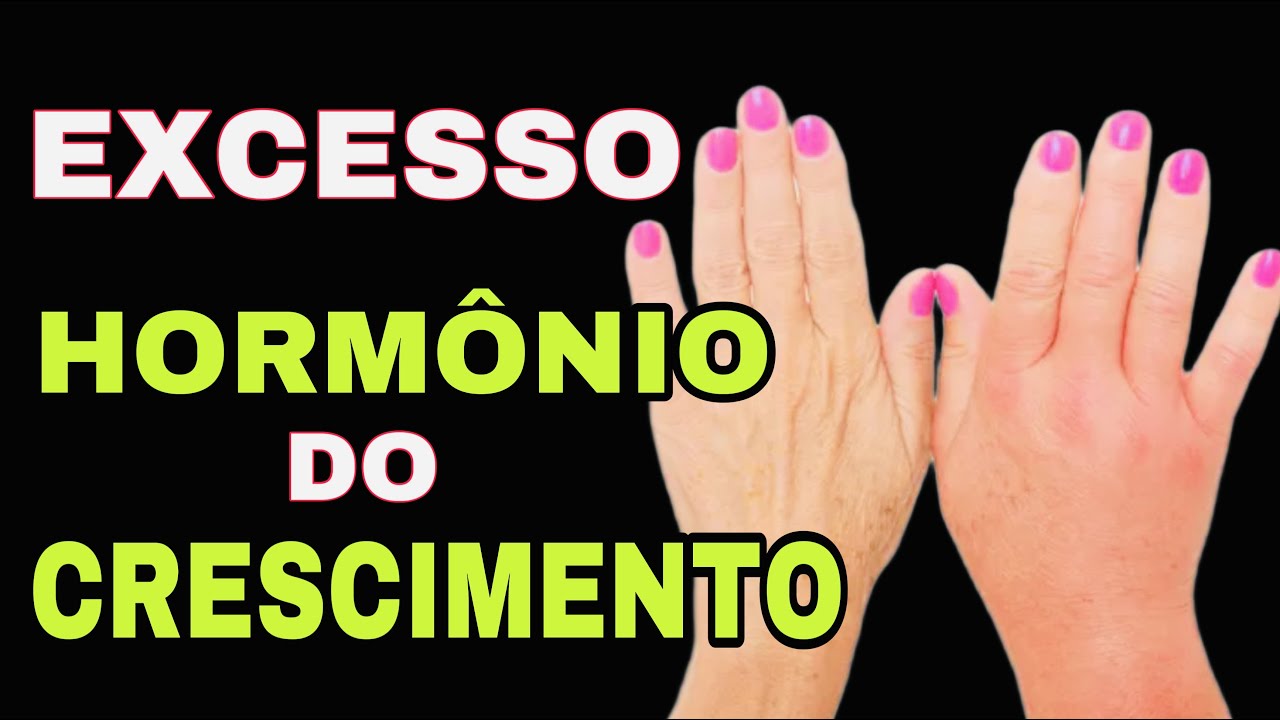 7 SINAIS no CORPO de EXCESSO DE HORMÔNIO DO CRESCIMENTO QUE VOCÊ NÃO PODE IGNORAR (GH - Acromegalia)