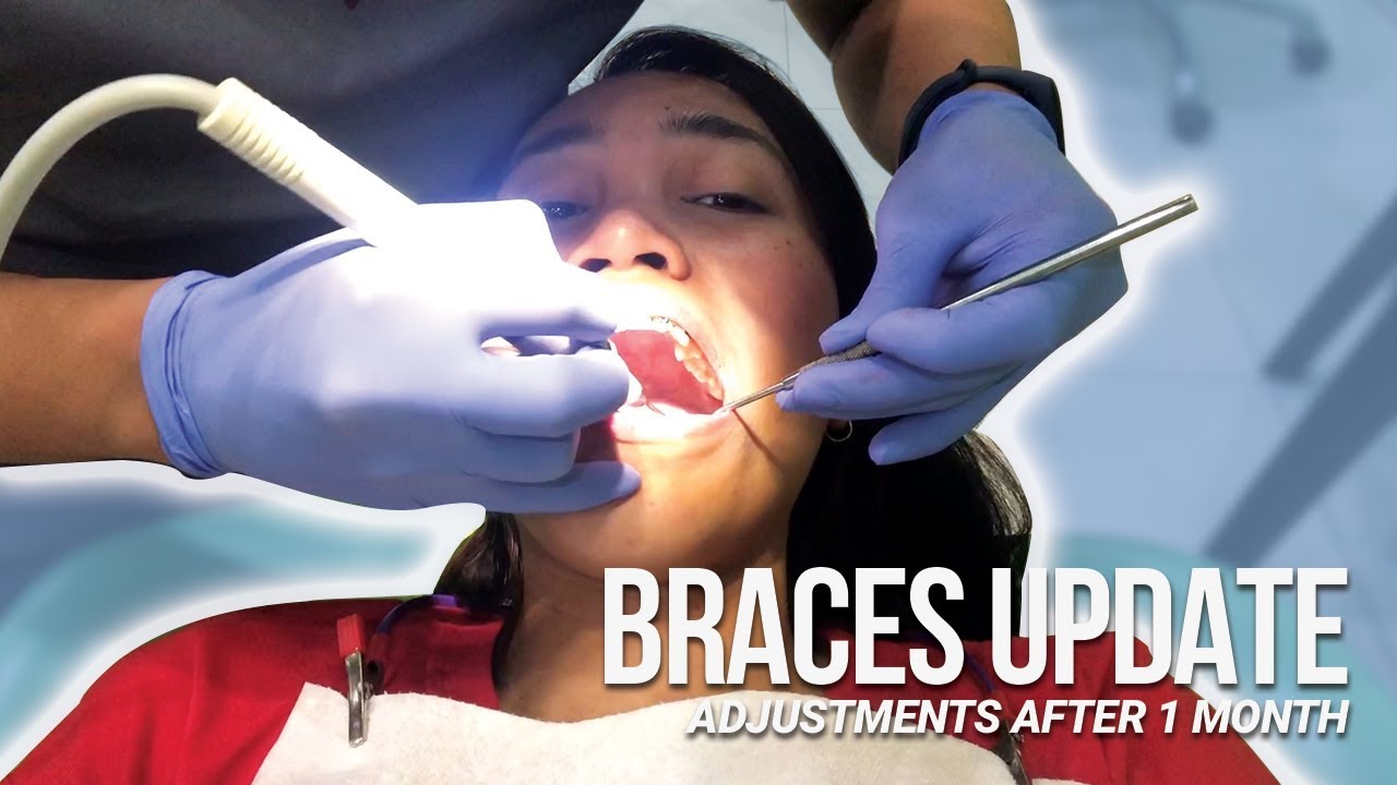 Braces update! First month adjustment Jhed Rañoja YouTube