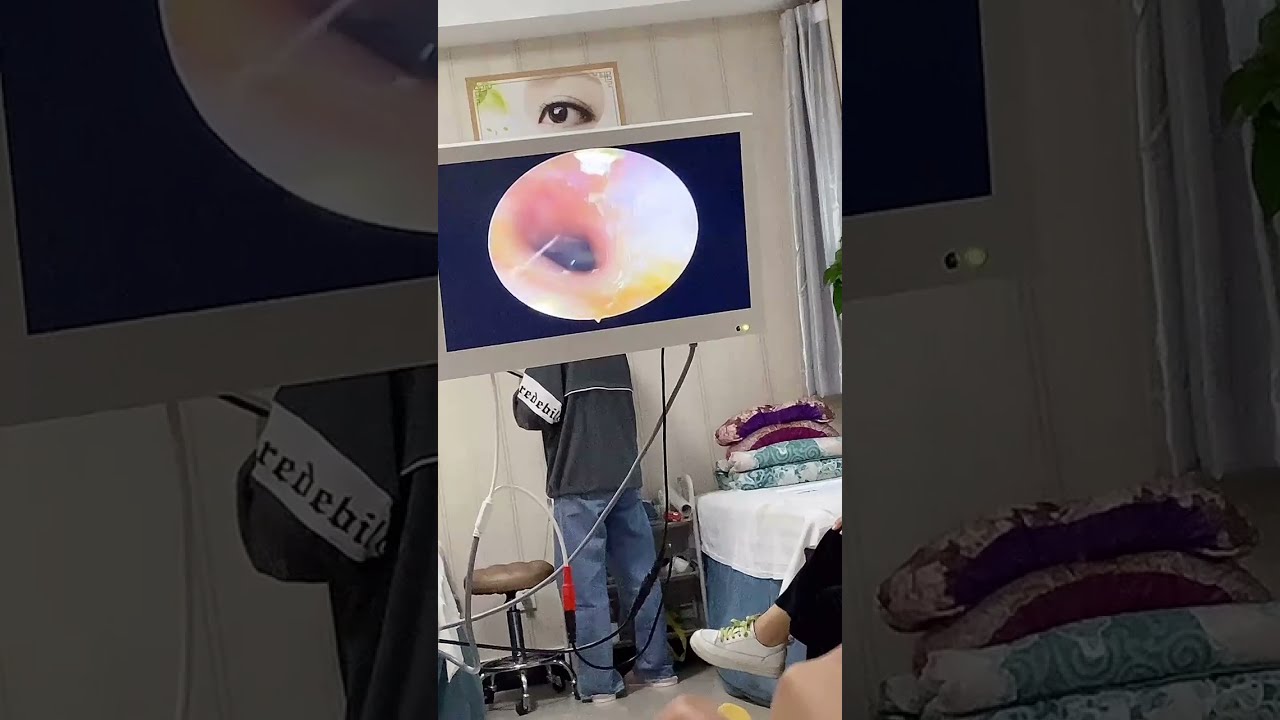 Satisfying Video Ear Wax Removal how to remove ear wax by endoscopic short P246 YouTube