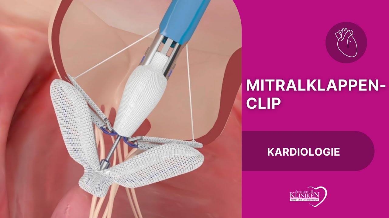 Mitralklappen Clip - Schonende Therapie bei Mitralklappeninsuffizienz