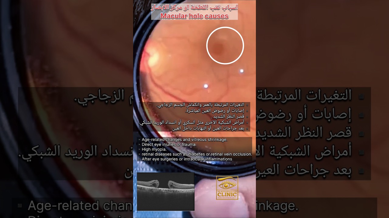 اسباب ثقب اللطخة macular hole causes #طبيب_عيون #العين #eyes #opthalmology #macularhole