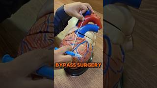 What is Bypass Surgery #bypass #bypasssurgery #cabg #heartattack #fyp