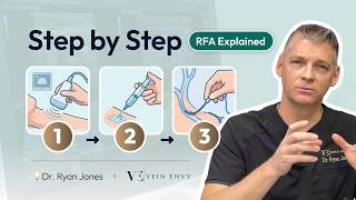 How Does RFA Work? Radiofrequency Ablation for Varicose Veins, Explained