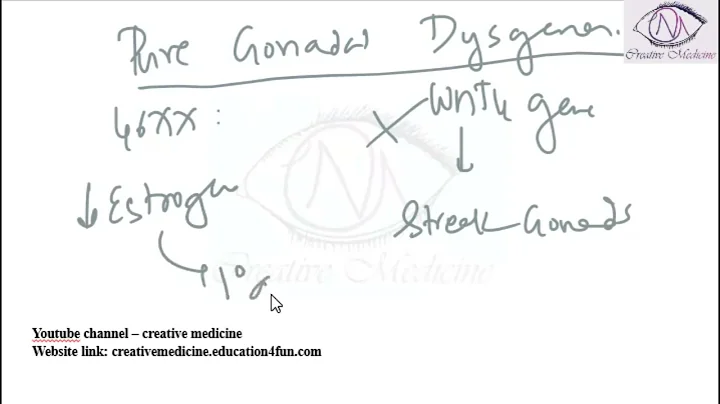 Lec 11 Primary Amenorrhea   Gonadal Dysgenesis