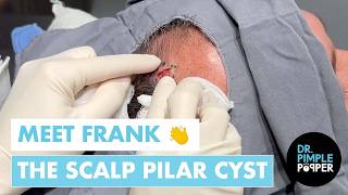 This Pilar Cyst Had A Name - Meet Frank