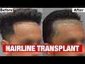 Natural looking hairline transplant at cara using sapphire fue method