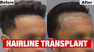 Natural Looking Hairline Transplant at Cara using Sapphire FUE Method screenshot 3