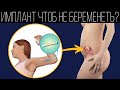 Как не забеременеть? Прогестиновые стержень | ПОЛЕЗНЫЙ ЮТУБ