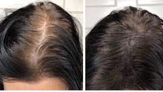 How I started growing new scalp Hair _  Hair Thickening Treatment Regrowz Review