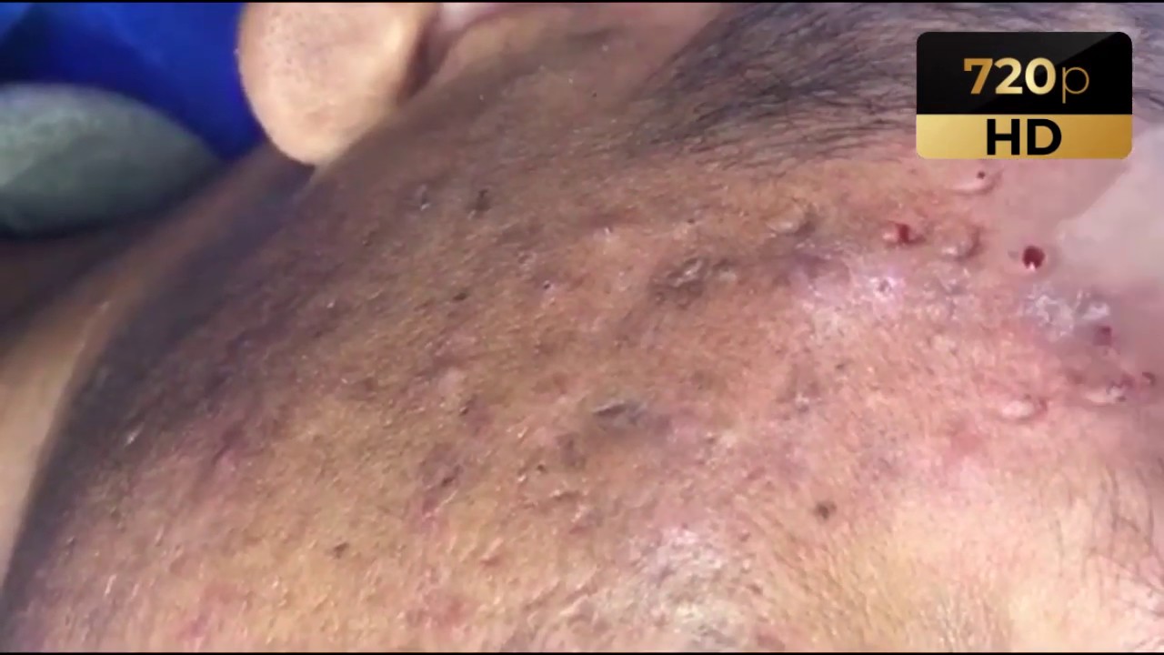 Blackheads Acne Removal 009 YouTube