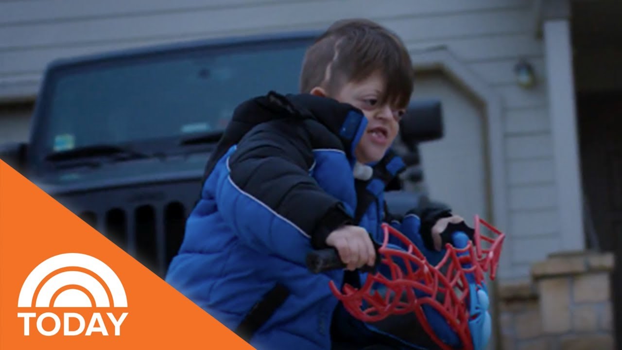 Meet Jameson, A Boy With A Facial Difference Who’s Perfect The Way He Is | TODAY