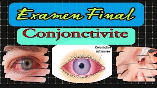 Conjonctivite الدرس كامل بالمختصر المفيد الرمد