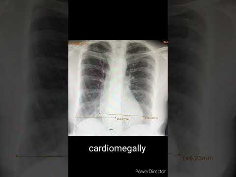 تضخم القلب وتشخيصه