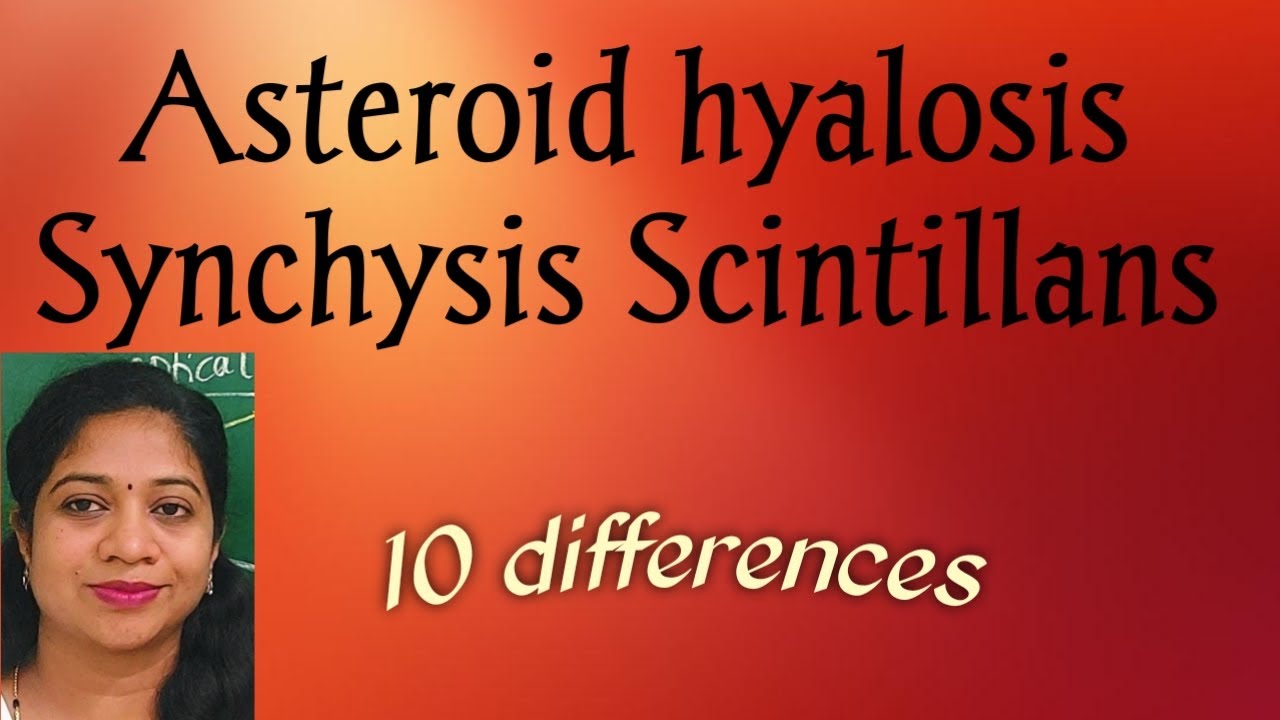 Asteroid hyalosis// Synchysis Scintillans// 10 differentiating points between these two conditions