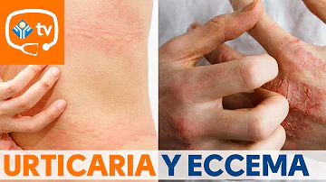 ¿Qué aspecto tiene el eczema de estrés?