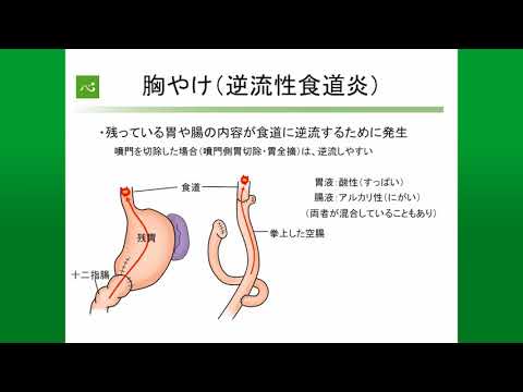 胃切術後障害