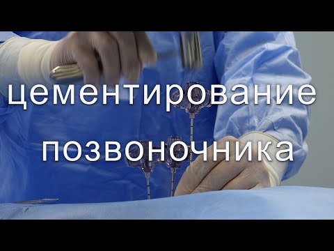 Вертебропластика или цементирование позвоночника