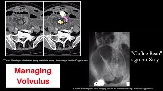 Volvulus (sigmoid vs cecal vs gastric)