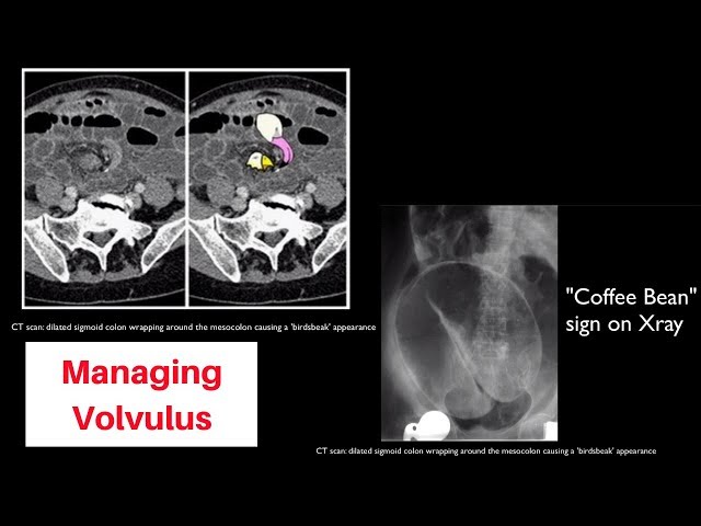 Types Of Volvulus Radiology