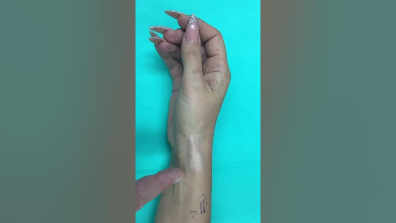 The danger ⚠️ of a cortisone shot in general and for De Quervain