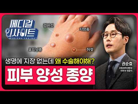 Skin Lumps: Should You Leave Them Alone? Diagnosis and Treatment of Benign Skin Tumors | Medical ...