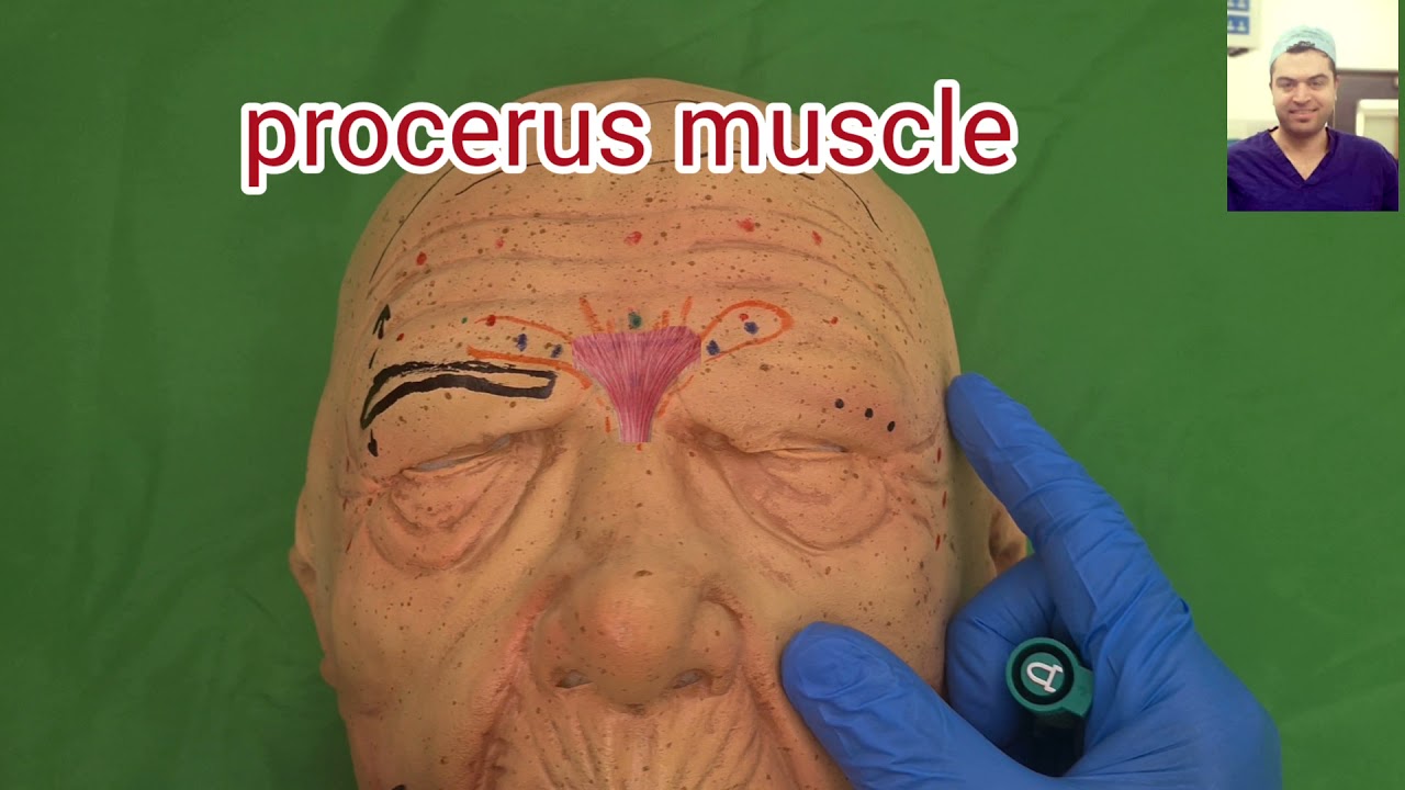 بوتكس ٣: حقن المنطقة حول العين botox