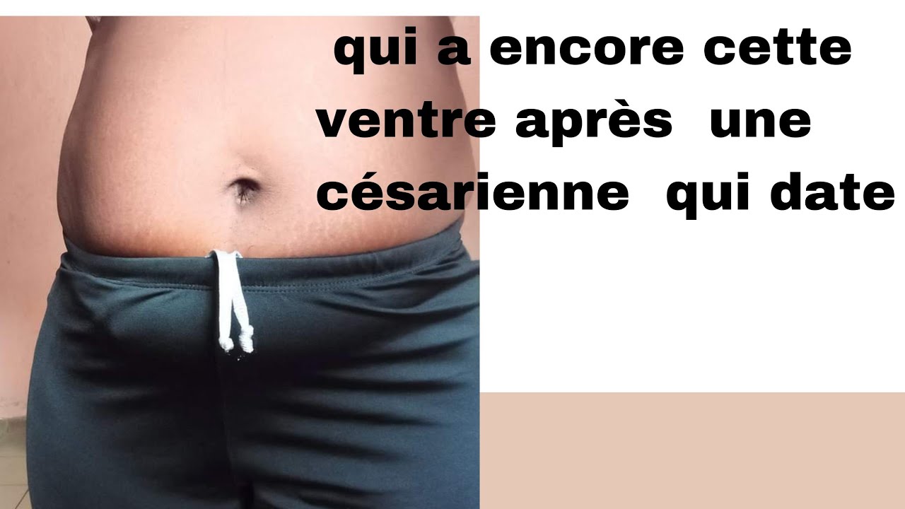 comment perdre son ventre après une césarienne ou par voie basse